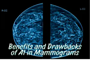 AI in Mammogram Analysis – Benefits & Risks