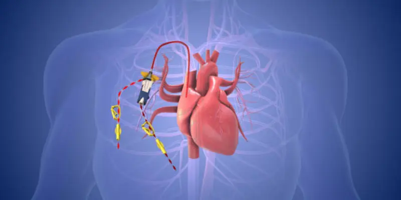 Ai Enhanced Catheters For Heart Care AI Powered Catheters for Heart