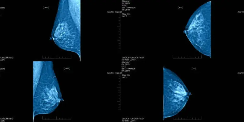 Less Mammogram Mistakes With Ai Fewer Mistakes in AI Mammograms